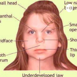 Fetal Alcohol Syndrome (FAS)