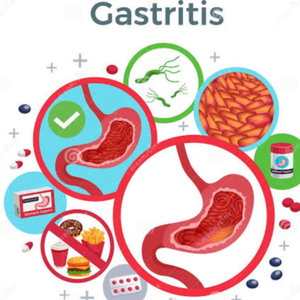 Gastritis Y Recomendación Nutrional