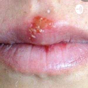 Herpes Simples