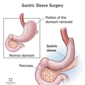 Living with a gastric sleeve 
