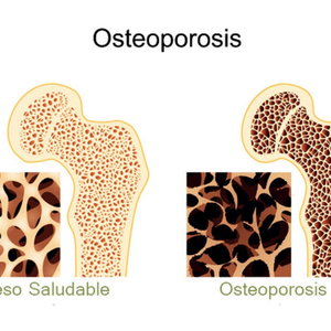 OSTEOPOROSIS