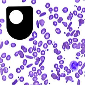 Sickle cell disease: a lethal advantage - for iPod/iPhone
